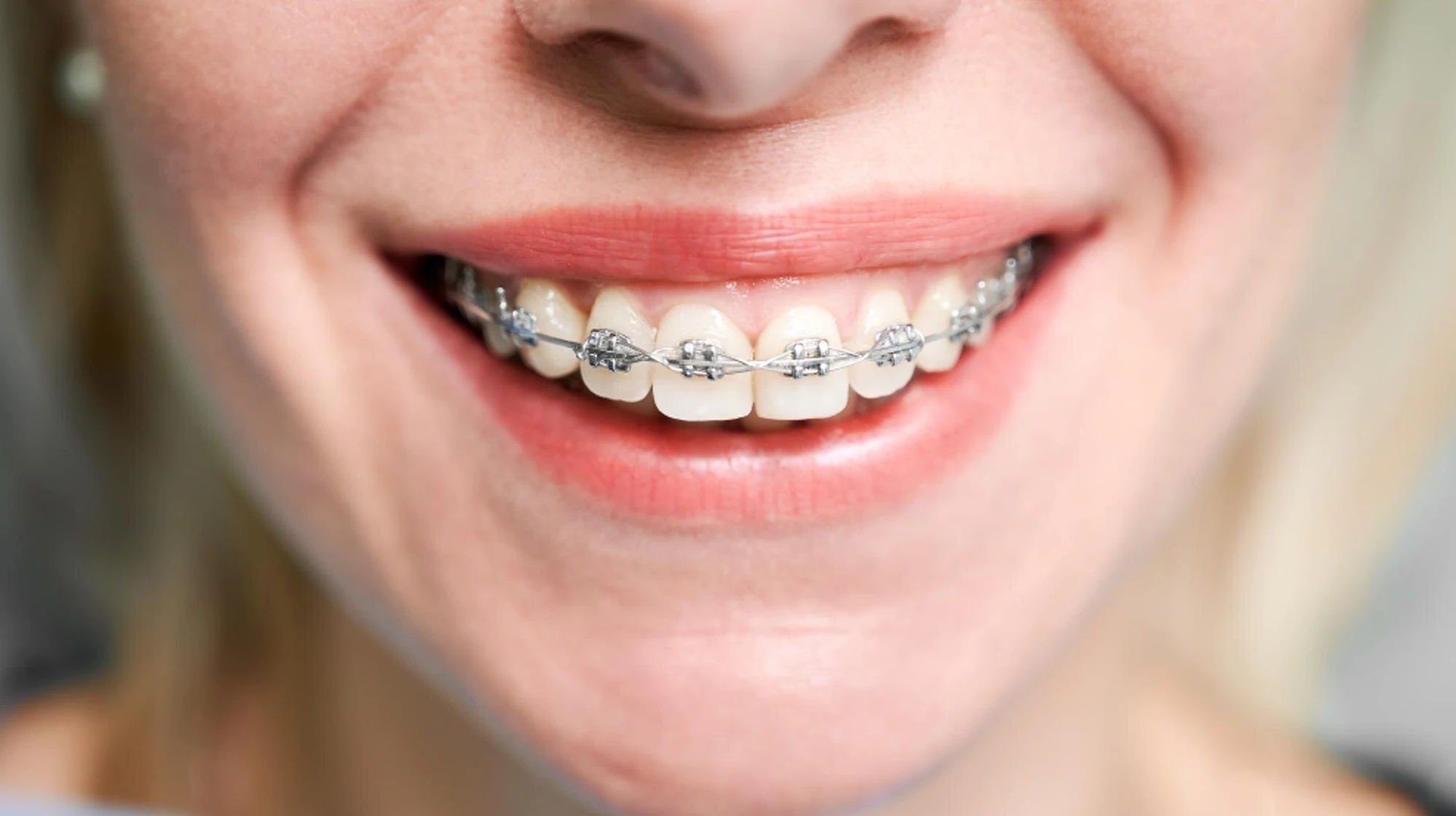 Şeffaf Plak (Invisalign)